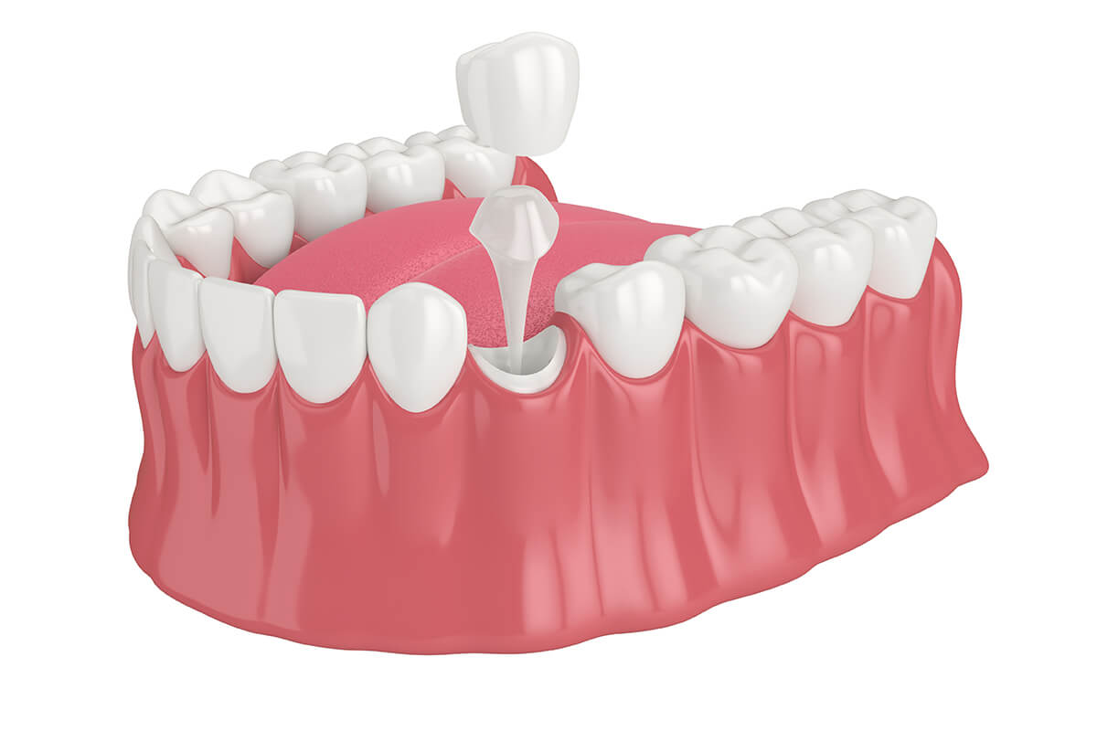 Porcelain Dental Crown in North Aurora IL Area